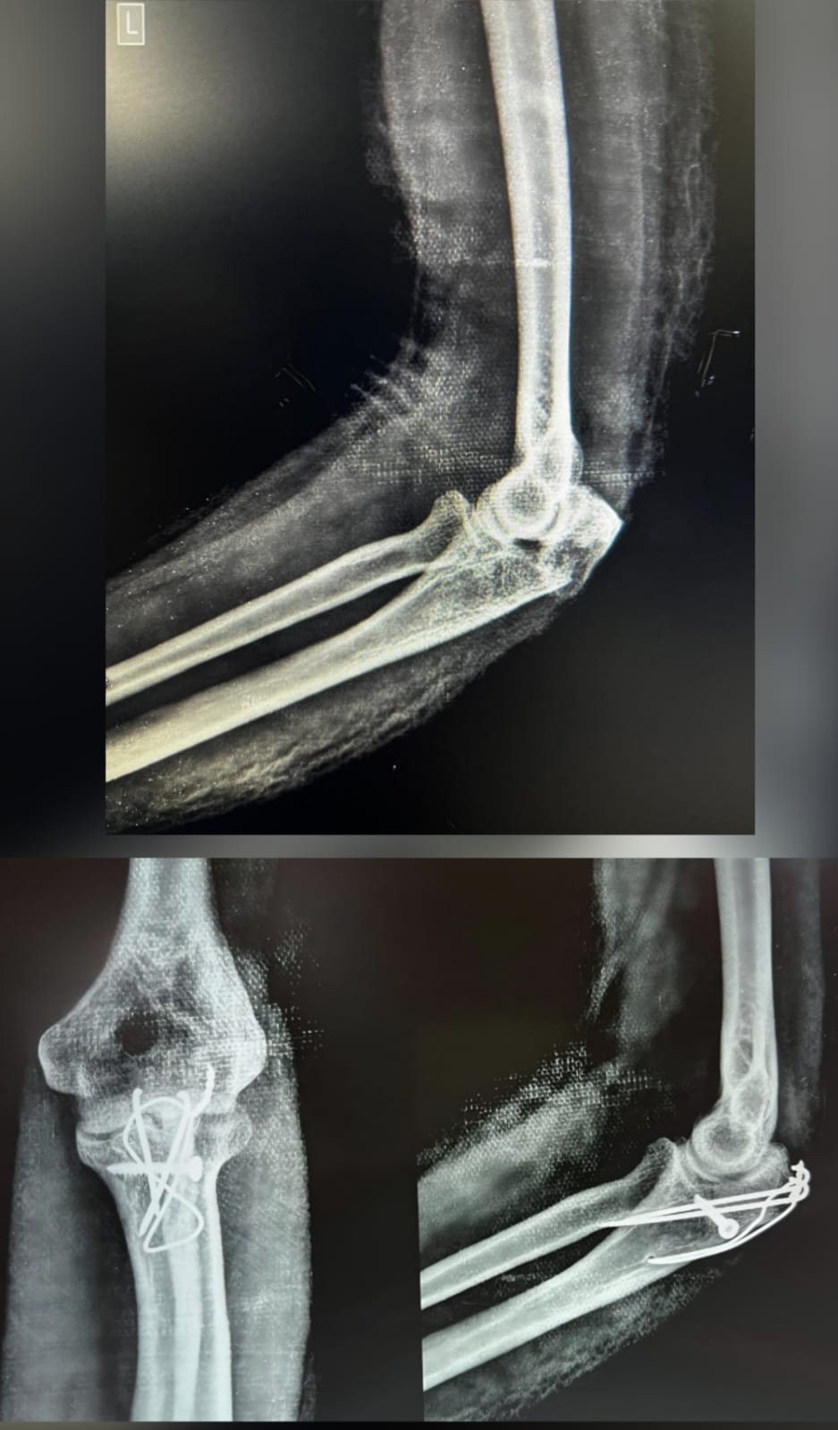 Elbow -olecranon fracture - ORIF TBW