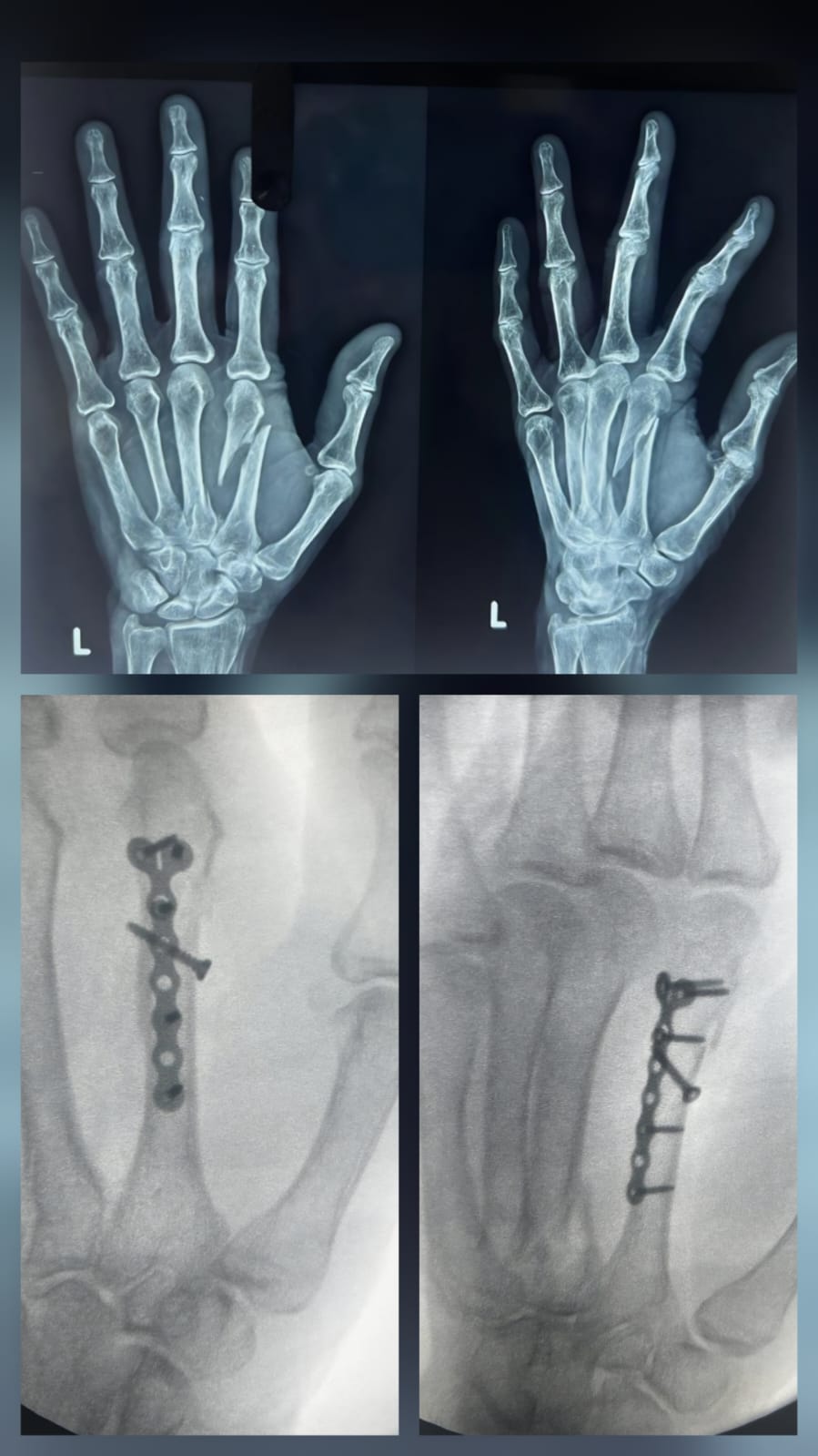 Hand fracture - metacarpal plating