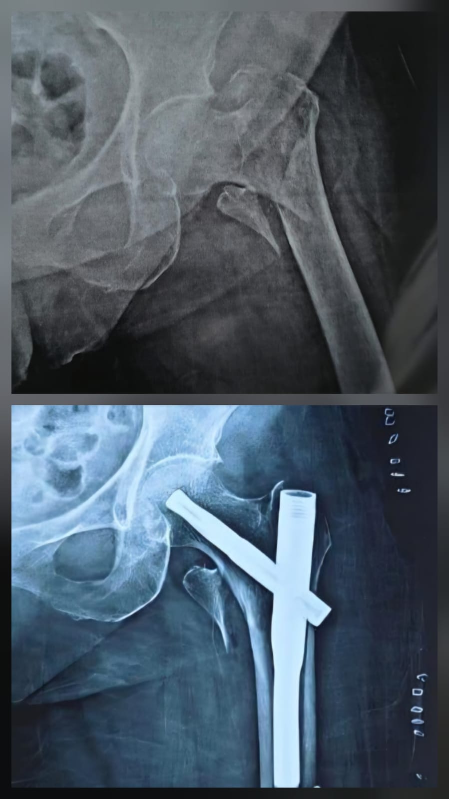Intertrochanteric femur fracture - PF nail