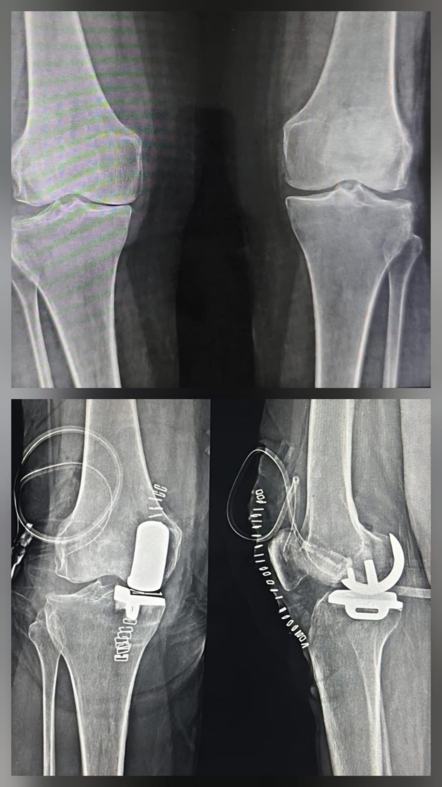 Partial or UNI-compartmental knee Resurfacing (UKR)