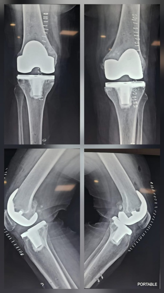 Post-Op Both Knee Robotic TKR X-Ray (After)