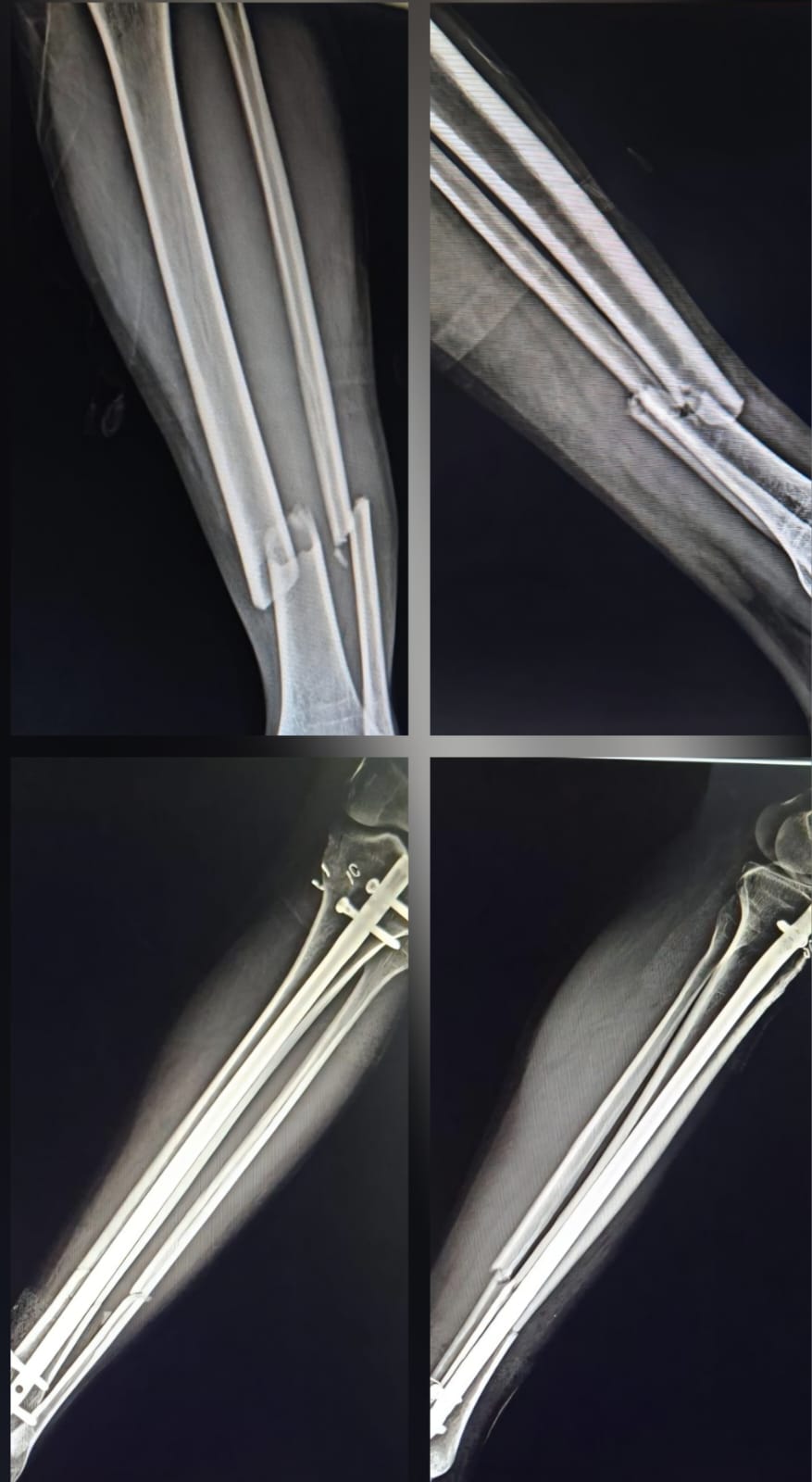 Tibia fracture - CR nailing
