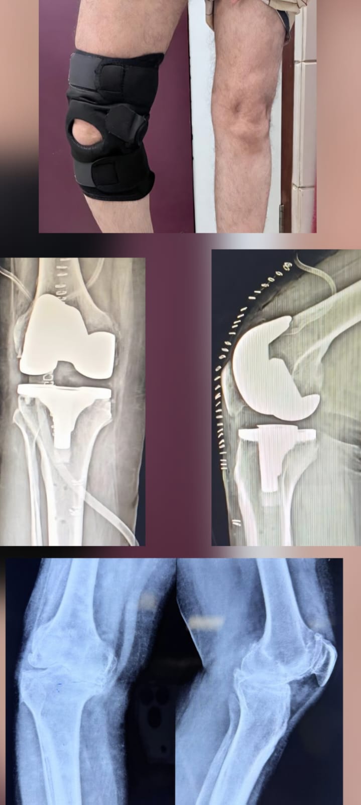 TKR Robotic - severe knee arthritis